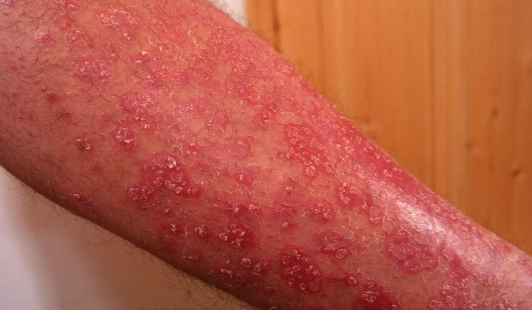 Malattie della pelle sempre più diffuse: al quarto posto tra tutte le patologie